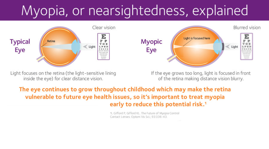 Myopia Sm Post Images 1200 X 630 Pixels 5 900x500