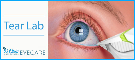 Tear Lab Collects Important Tear Data To Determine If You Have Dry Eye Disease