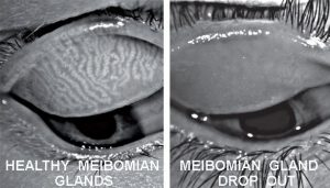 Infra Red Meibography