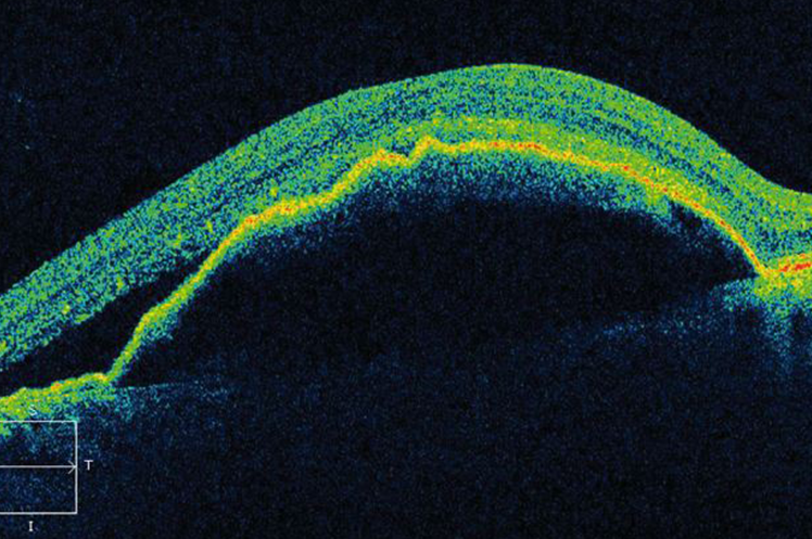 Pigment Epithelial Detachment