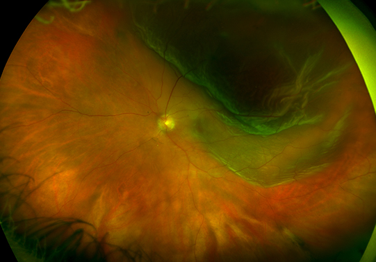 Retinal Detachment Deep