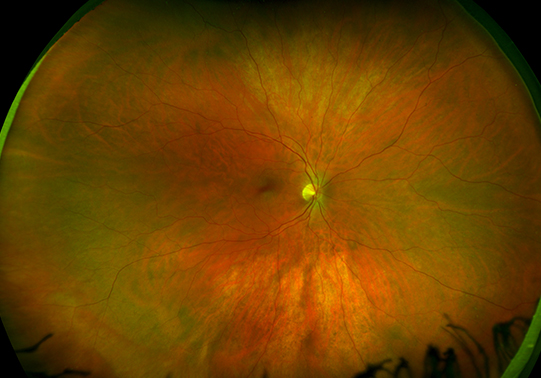 Healthy Retina