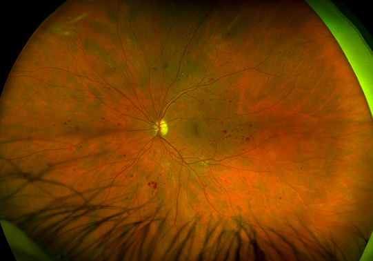 Diabetic Retinopathy