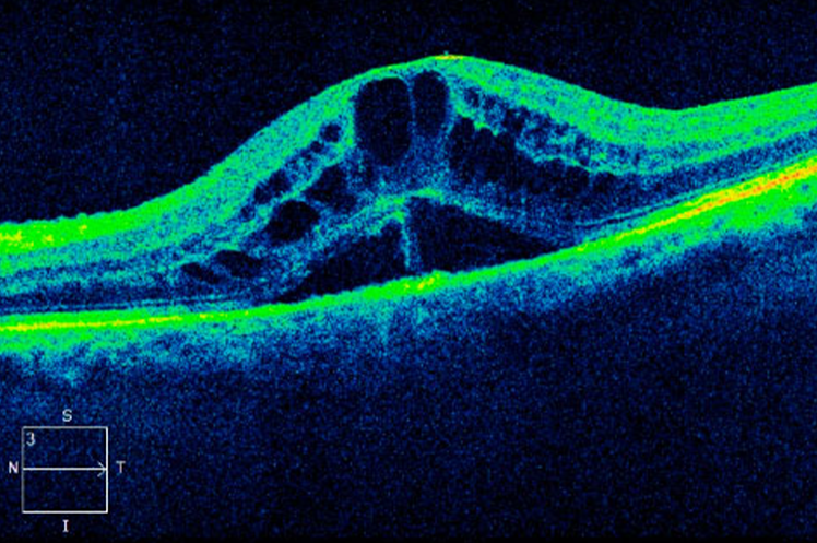 Diabetic Macular Edema