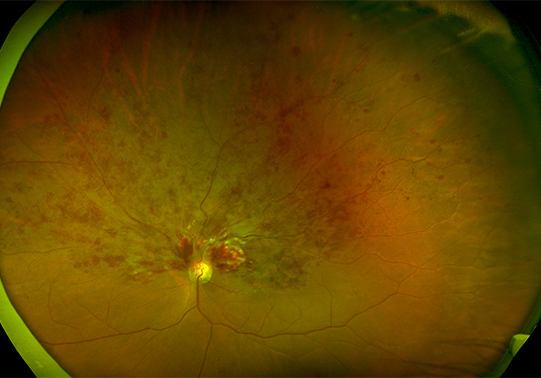 Retinal Vein Occlusion