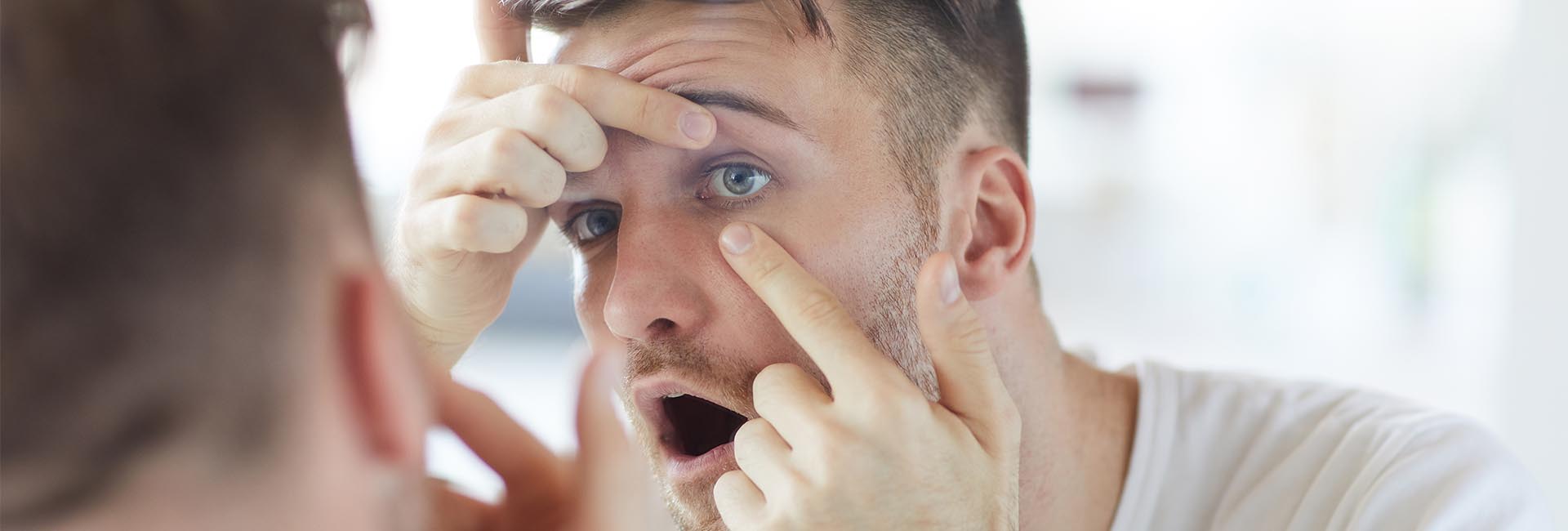 Contact Lens Irritation