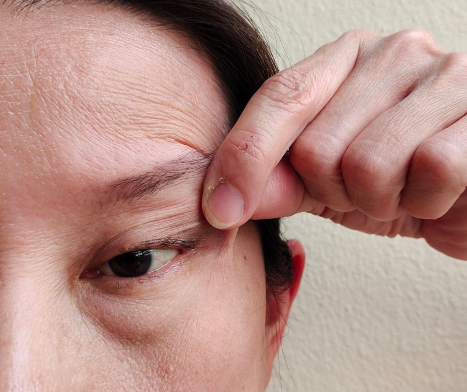 Understanding Ptosis